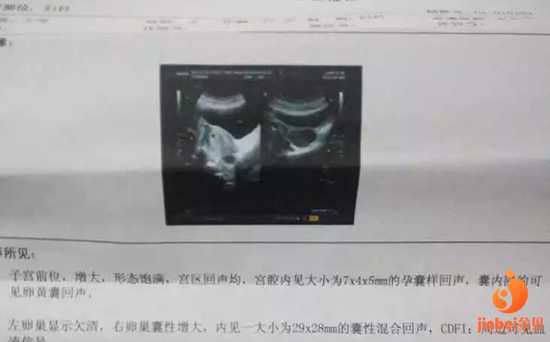 昆明医院供卵费用：【南京哪个医院供卵好】37+3周，生产狗年宝宝，分享一下（下）